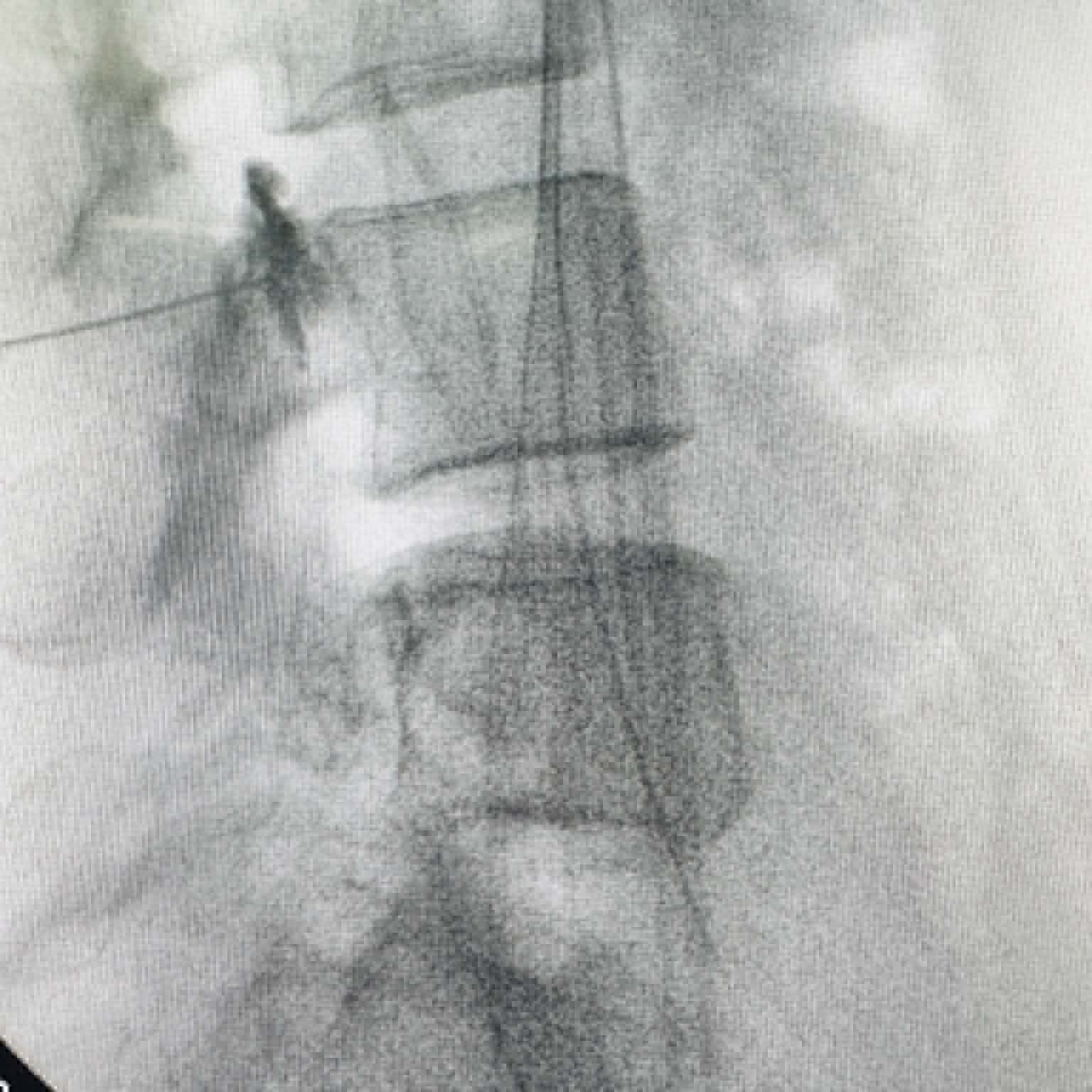 Fluoroscopy clinical image 02