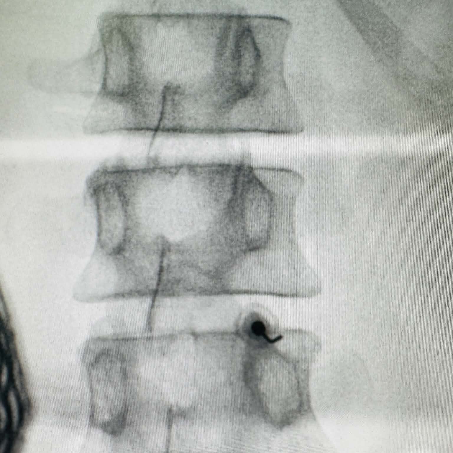 Fluoroscopy clinical image 11