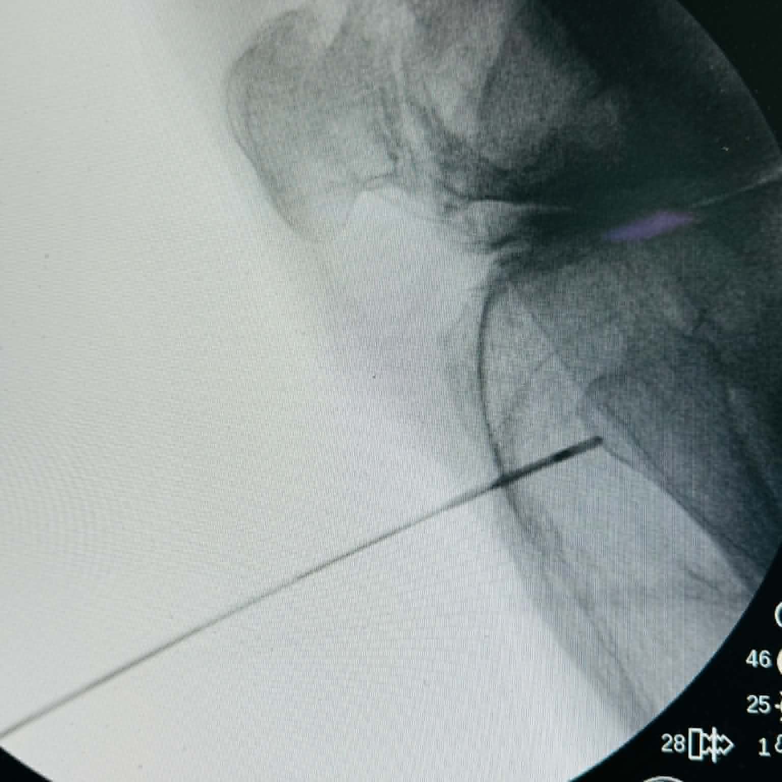 Fluoroscopy clinical image 18