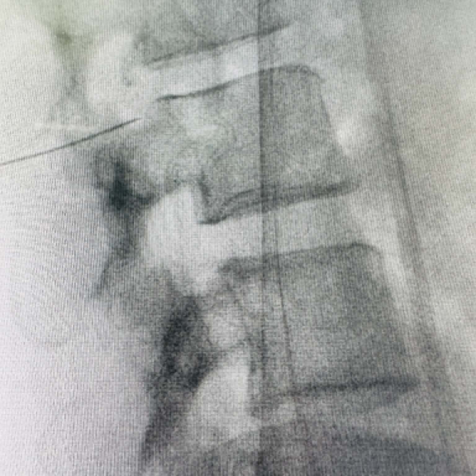 Fluoroscopy clinical image 20